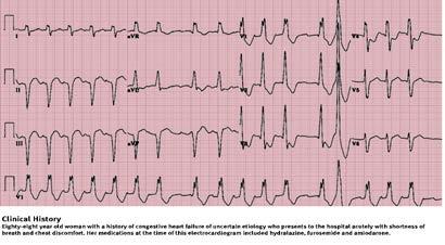 A Wide QRS