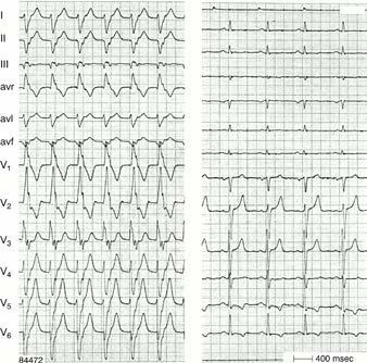 Find the P wave / Match P s & QRS s AV dissociation virtually diagnostic of VT But only apparent in ~1/3 of WCT due to VT Capture and fusion beats seen in VT: When a dissociated P wave causes total