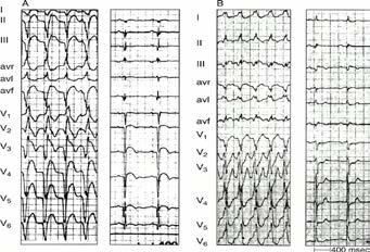 66 yo man with palpitations and syncope RBBB morphology Monophasic QRS in V 1 Closer look at QRS: Morphology (cont d) LBBB WCT: VT is suggested by notch R > 30 ms S > 70 ms Closer look at QRS: