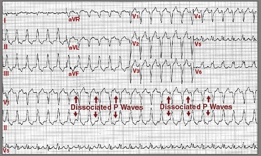 140-250 Regular wide QRS High risk of sudden death, especially in poor LV function Idiopathic VT arising from RV outflow tract Usually from RVOT (LBBB morphology) Occurs with increased sympathetic