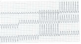 / AF with WPW (posteroseptal AP) Practice Tracing #3 Practice Tracing #4 WCT: VT