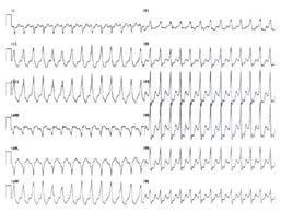 Practice Tracing #5 Practice Tracing #6 WCT: VT most likely Rate 170: no help Regular: yes = no help AV Diss: yes = VT Axis: nl = SVT QRSd: 180 ms > 160 = VT QRS concordance: