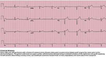 ECG recorded after IV adenosine What is