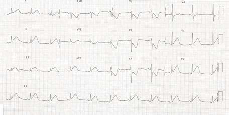 Closer look at QRS: compare to sinus QRS Tachycardia QRS morphology similar to