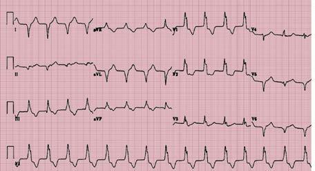 True posterior wall MIpossible occlusion of RCA?