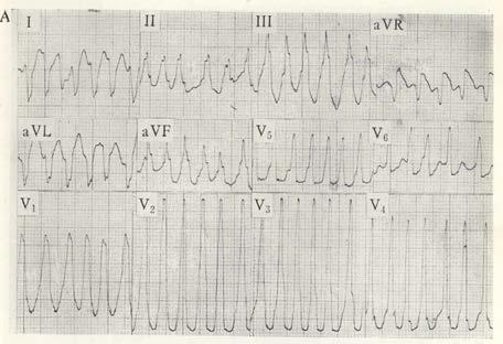 Accelerated Idioventricular Rhythm (AIVR) Arises from ventricle (Purkinje fibers) Generally peri-infarct rhythm Rate 60 120 Regular, wide QRS Generally self-terminating Not necessarily an indicator