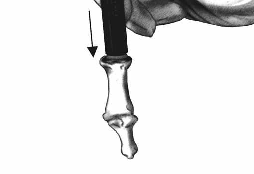 The taper should be wiped clean and the head should be seated using the Metatarsal Head Impactor with a mallet.