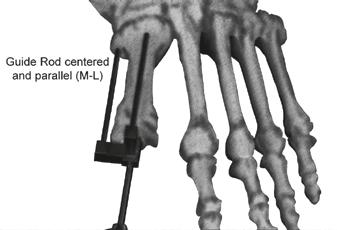 Guide Pin until the Guide Rods are parallel and centered on the metatarsal (Figures 5 & 6).