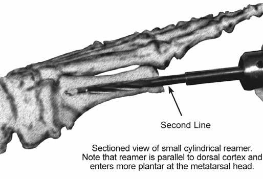 If continuous resistance is encountered, it is likely that the pin is misdirected and is engaging the cortical wall of the metatarsal diaphysis.
