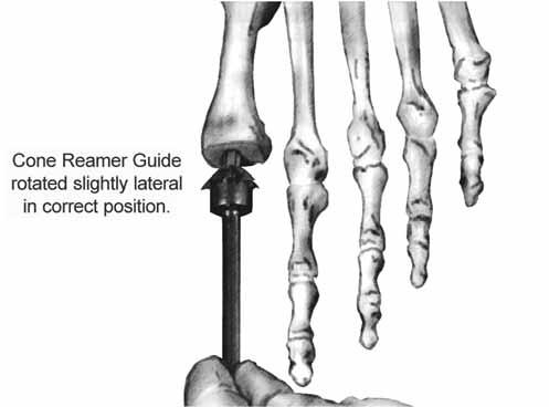 A general rule of thumb is that the reamer stem should be parallel with the second toe (provided there are no deformities of the second toe) (Figure