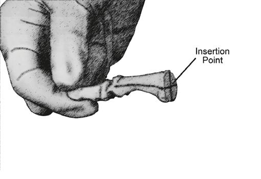 ALIGNMENT Align the Phalangeal Guide Pin parallel with the shaft of the proximal phalanx M-L (Figure 21) and direct toward the dorsal aspect of the IP joint in the D-P