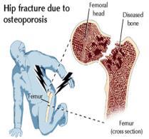 Osteoporosis Diagnosis Osteoporosis can be diagnosed by: DEXA scan* Presence of Fracture resulting from a low energy fall Low energy fracture is diagnostic of osteoporosis (in the absence of other
