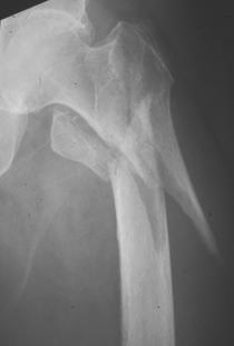 Hip Fractures Are the Key Hip fractures 87% of total cost of