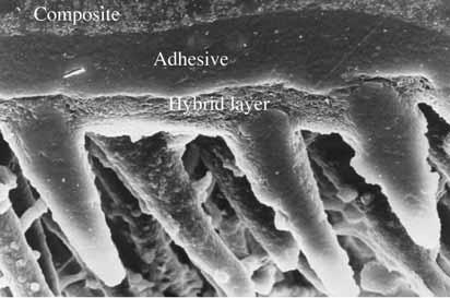 Perdigao, University of Minnesota The open dentin tubules create a surface where adhesive can penetrate and form resin tags.