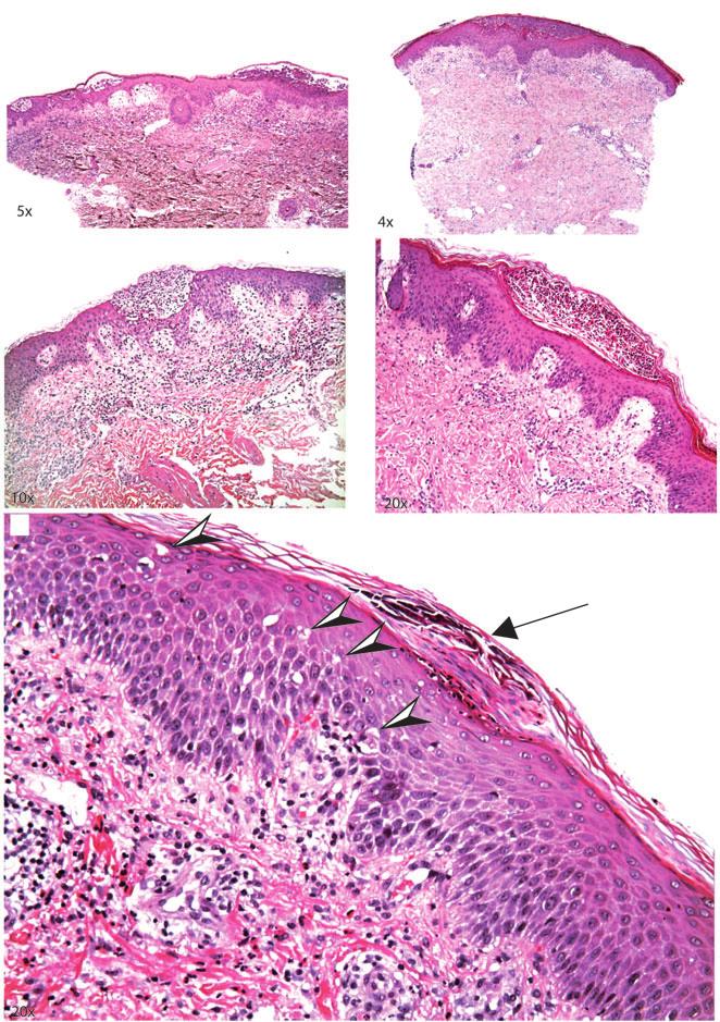 Histopathology of AGEP GPP (A) (B) (C) (D) (E) Fig. 1. Histopathology of acute generalized exanthematous pustulosis. A) Spongiform pustules at various epidermal levels.