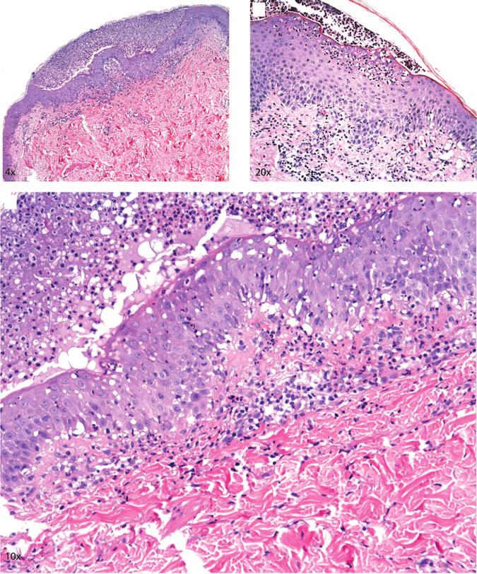 Kardaun et al. (A) (B) (C) Fig. 3. Histopathology of acute generalized pustular psoriasis (agpp).