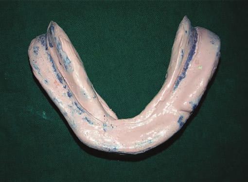 with admixed impression material loaded on temporary denture base (Fig. 8). Height of neutral zone record was determined by referring anatomic landmarks, such as height of lower lip.