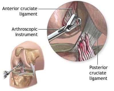 Tests, such as blood samples or a cardiogram, may be ordered prior to surgery if needed. Your Arthroscopic Knee Surgery Almost all arthroscopic knee surgery is done on an outpatient basis.