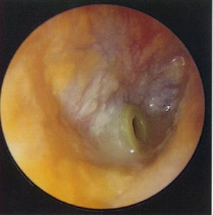 middle ear (fever,