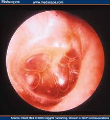 Otitis Media with Effusion Effusion without signs of acute inflammation Dull,
