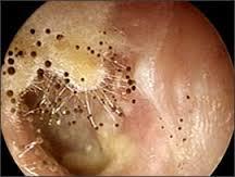 Fungal Otitis Externa May be associated with use/overuse of topical