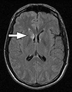 cortical association areas -> language, memory, visuospatial deficits Clinical presentation: