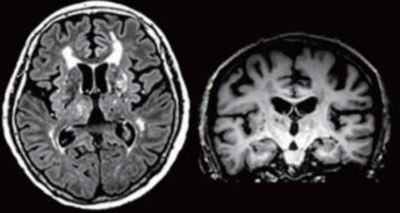Subcortical Ischemic Vascular Progressive cognitive and functional decline due to recurrent small-vessel ischemic strokes Deficits due to: Disruption of frontalsubcortical circuits;