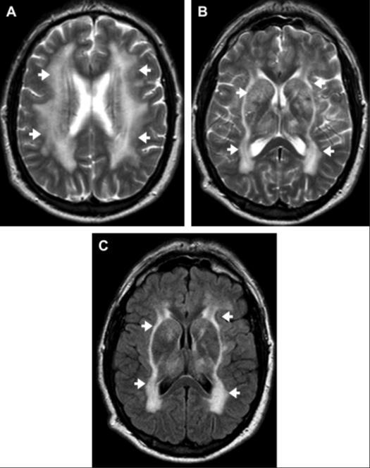 Binswangers Disease Chronic hypoperfusion results in thinning and attenuation of the white