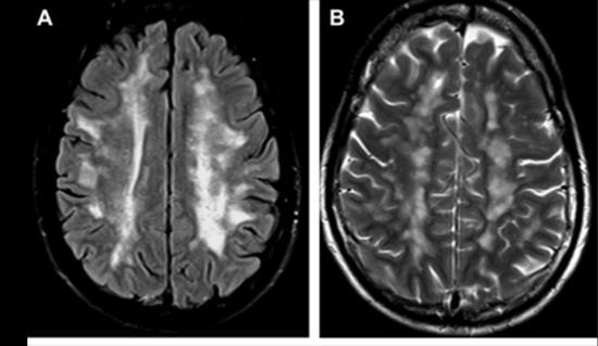 CADASIL Cerebral Autosomal Dominant Arteriopathy with