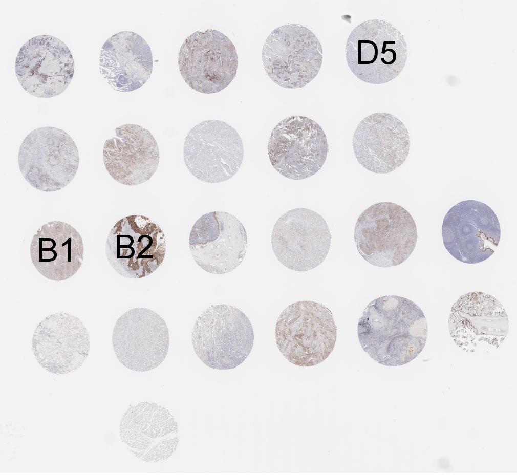 1b) Internal ring trial: Staining NSCLC-TMA, 2mm cores, n=21 Sections cut at central lab Staining and scoring at local labs - 10 institutes - 4 clinical trial assay (CTAs)