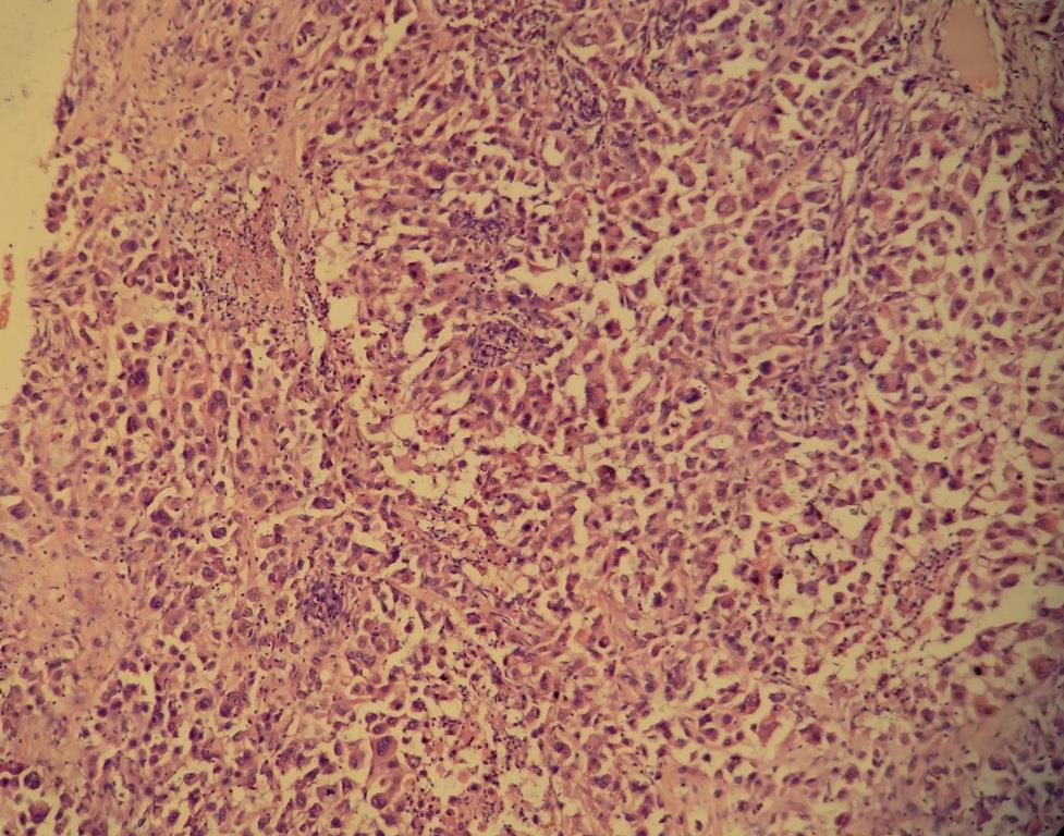 IHC was performed for cytokeratin and vimentin which showed strong positivity in the tumor cells. Desmin was negative. Fig.