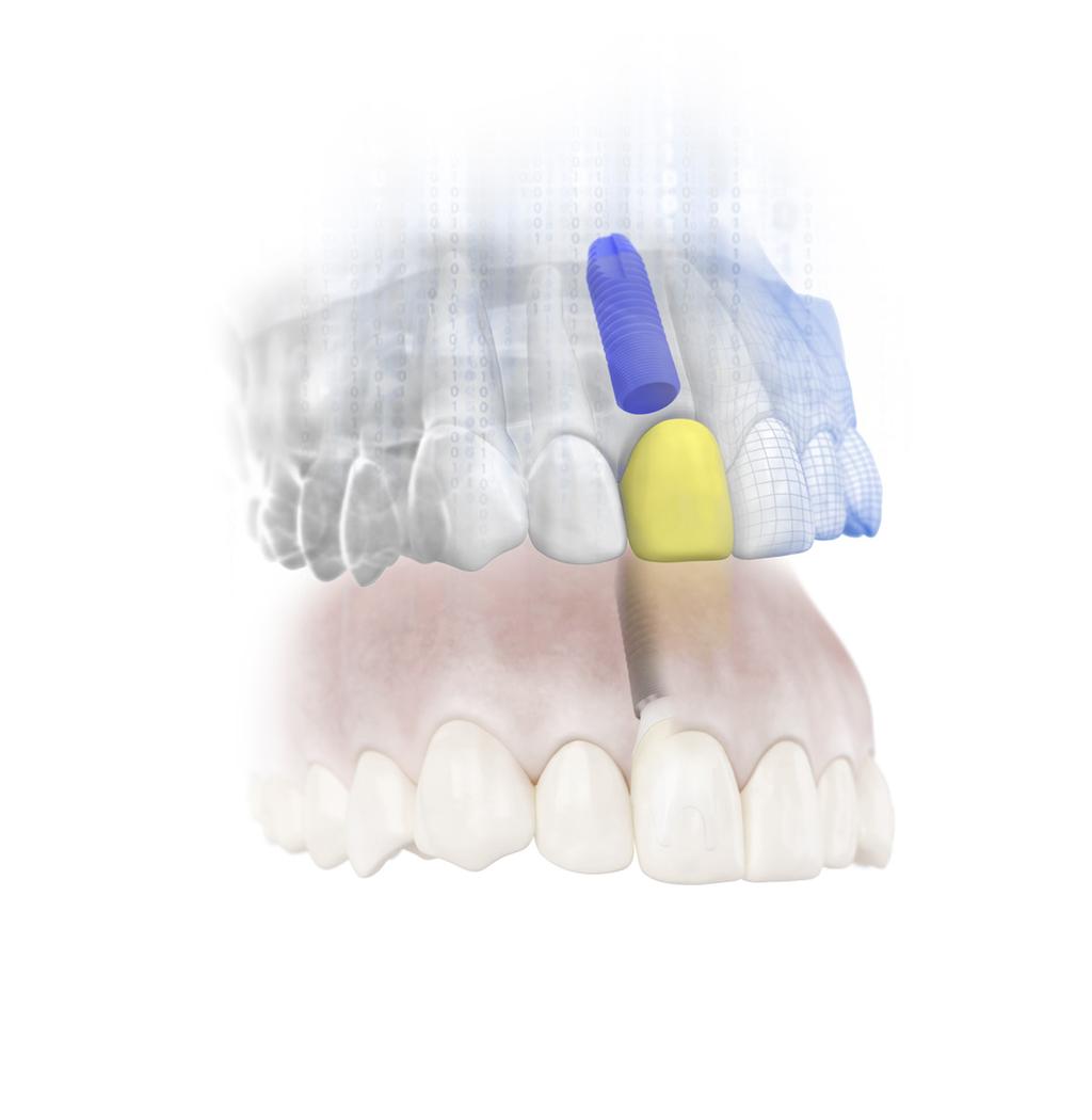 The SIMPLANT Guide and the ATLANTIS Abutment in titanium, gold-shaded titanium or zirconia are delivered at implant installation, together with the temporary crown.