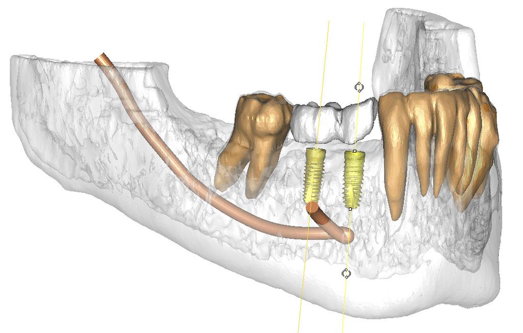 The SIMPLANT Guide forms a link between the digital treatment plan in SIMPLANT and the surgery. Precise planning and implant placement enables minimal invasive treatment as well as reduced chair time.