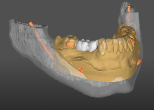 With SIMPLANT, you can create a 3D implant plan that considers both surgical and prosthetic aspects, including: Evaluation of the clinical situation from the anatomical information in the (CB)CT