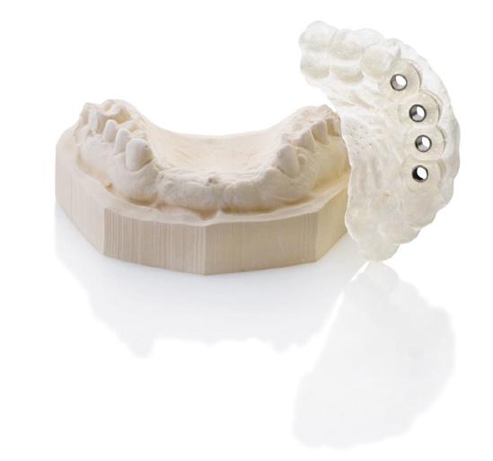 Mucosa-supported For fully edentulous cases when minimally invasive surgery is preferred.