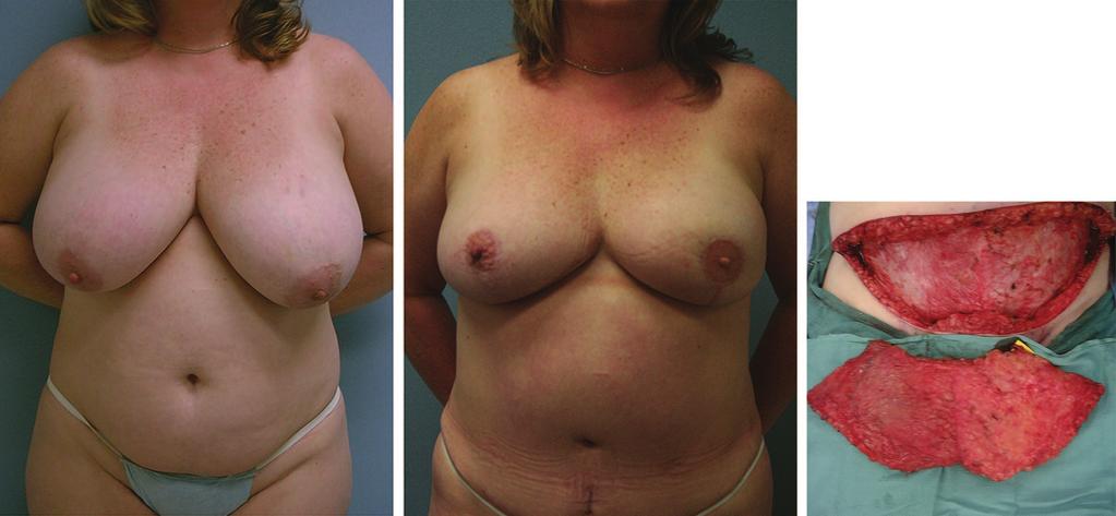 Plastic and Reconstructive Surgery November 2007 Fig. 3. (Left) A 44-year-old woman diagnosed with left-sided breast cancer. Notice the bilateral grade II ptosis preoperatively.