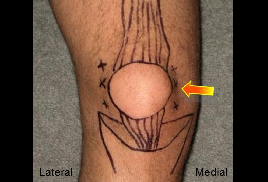 Knee Medial Retropatellar - Keep knee straight / extended - Palpate the