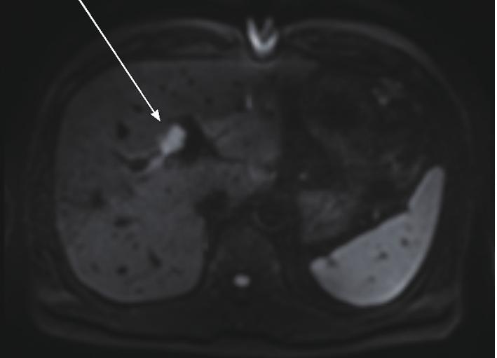 Mass-Forming IgG4-Related Cholangitis 301 sion at hilar bile duct. Magnetic resonance imaging (MRI) revealed a 2.1-cm-sized relatively well-demarcated mass at bifurcation of the left hepatic duct.