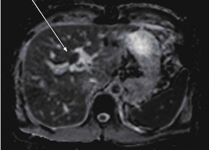was considered to be resectable. Preoperative evaluation of positron emission tomography (PET) showed multiple enlarged lymph nodes in left axillary, common hepatic, portocaval, and aortocaval areas.