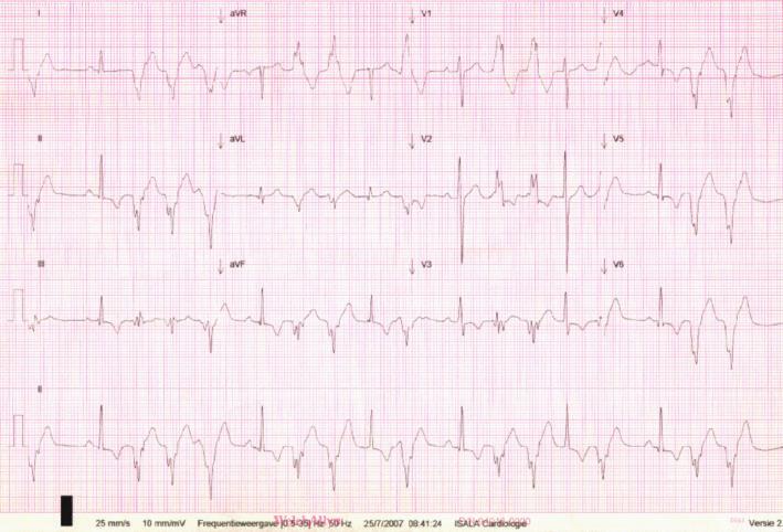 2 Case Reports in Cardiology Figure 1: Twelve lead ECG showing ventricular bigeminy, doublet PVC s with an RBBB configuration with an RS interval of >0 msec in the precordial leads, and a pseudodelta