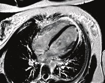 Case Reports in Cardiology 5 RHA Abbreviations VT: Ventricular tachycardia PVC: Premature ventricular complex RBBB: Right bundle branch block MRI: Magnetic resonance imaging LVEF: Left ventricular
