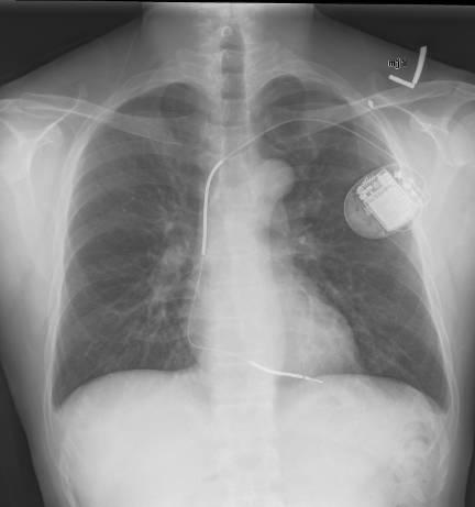 Defibrillators Primary prevention of sudden cardiac death LVEF 35% NYHA