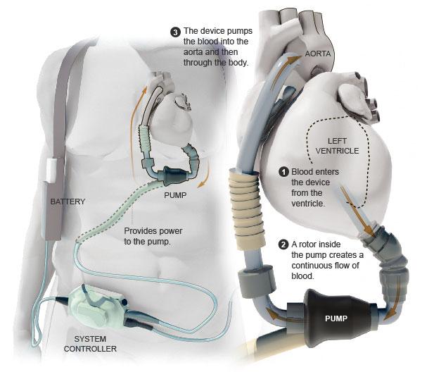 Continuous Flow LVAD Heartmate II (Thoratec) Rotating impellers with minimal