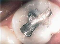 B- condition of teeth.