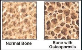 normal bone height Regular trabecular pattern Heavy cortical layer