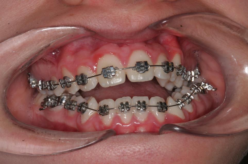 Slika 18. Ispitanik sa izraženom teskobom u zubnom nizu.