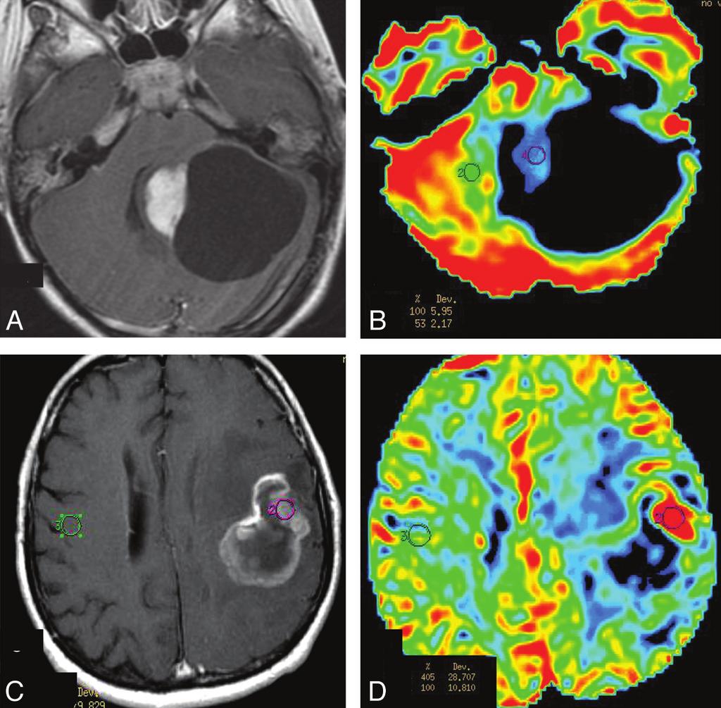 FIG 1. Comparison of rcbv between PA and HGA on PWI. A and B, Solid-cystic PA in the left cerebellar hemisphere.
