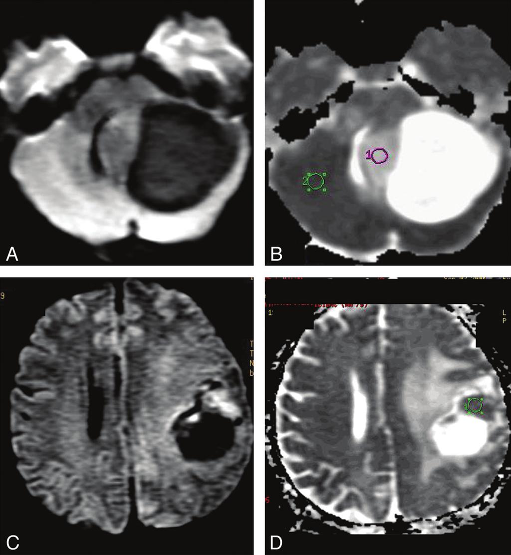 FIG 2. DWI in PA and HGA. A and B, Solid-cystic PA in the left cerebellar hemisphere.