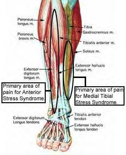 Medial Tibial Stress Syndrome (MTSS)(Shin Splints) Pain along the posterior medial border of the tibia Periostitis with