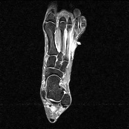 Stress Fractures Microfracture in bone that results from